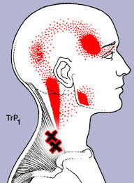 Trigger point of Trapezius muscle