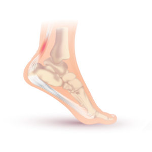 Calf Pain.  Achilles Tendonitis.  Achilles Tendinosis.